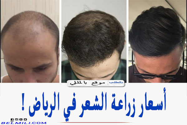 أسعار زراعة الشعر في الرياض 1443 وأفضل الأماكن بالمللي